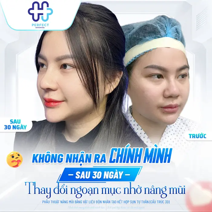 Nâng Mũi Sụn Tự Thân Giữ Được Bao Lâu? Giải Đáp Chi Tiết