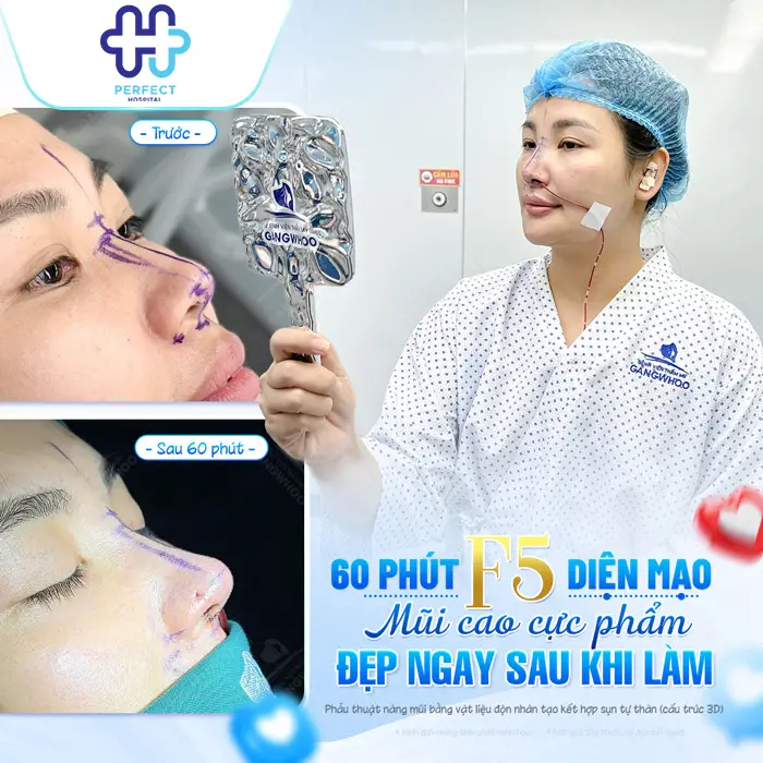 Nâng Mũi Sụn Tự Thân Giữ Được Bao Lâu? Giải Đáp Chi Tiết