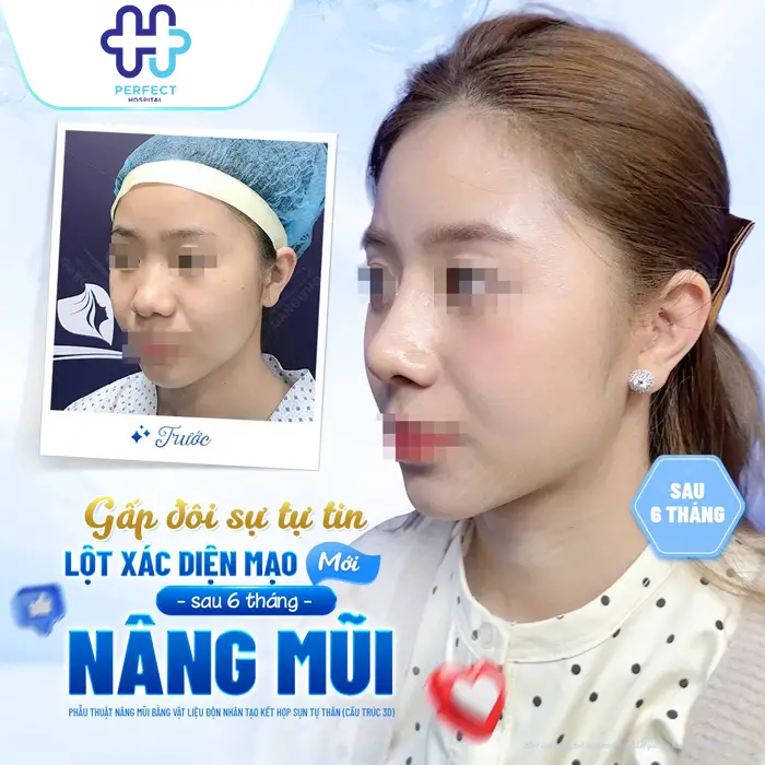 Nâng Mũi Sụn Tự Thân Giữ Được Bao Lâu? Giải Đáp Chi Tiết