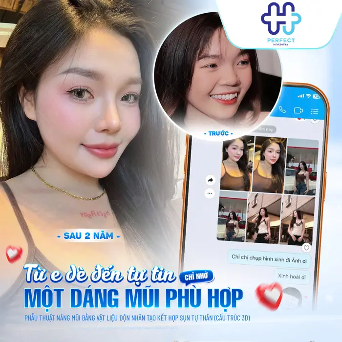 Nâng Mũi Sụn Tự Thân Giữ Được Bao Lâu? Giải Đáp Chi Tiết