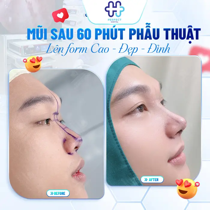 Nâng Mũi Tự Thân Giá Bao Nhiêu Và Chi Phí Có Đắt Không