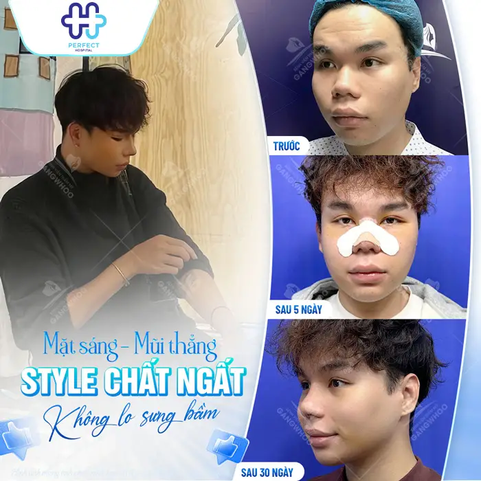 Nâng Mũi Tự Thân Giá Bao Nhiêu Và Chi Phí Có Đắt Không