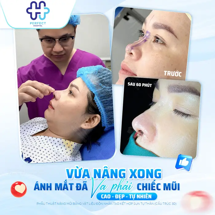 Nâng Mũi Tự Thân Giá Bao Nhiêu Và Chi Phí Có Đắt Không