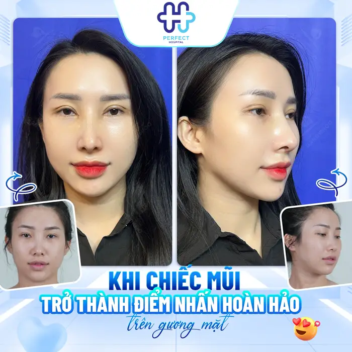 Nâng Mũi Tự Thân Giá Bao Nhiêu Và Chi Phí Có Đắt Không