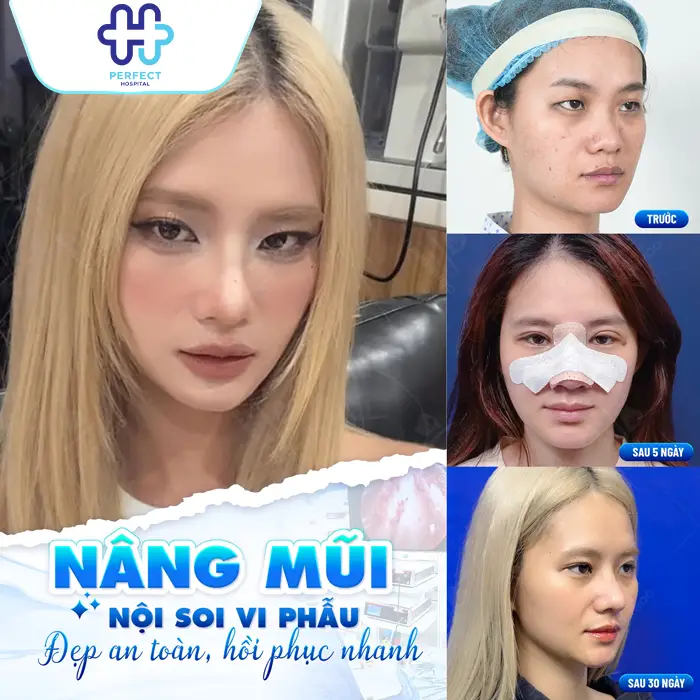 Nâng Mũi Tự Thân Giá Bao Nhiêu Và Chi Phí Có Đắt Không