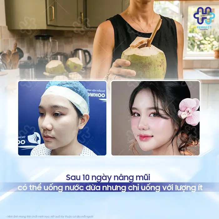 Nâng Mũi Uống Nước Dừa Được Không? Khi Nào Nên Uống Lại?