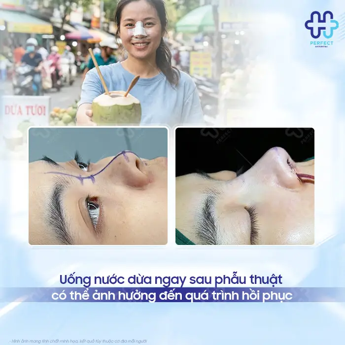 Nâng Mũi Uống Nước Dừa Được Không? Khi Nào Nên Uống Lại?