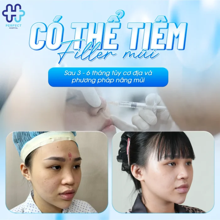 Nâng Mũi Xong Có Tiêm Filler Được Không? Lưu Ý Quan Trọng