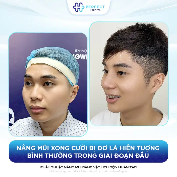 Bác Sĩ Giải Đáp: Nâng Mũi Xong Cười Bị Đơ Và Cách Khắc Phục
