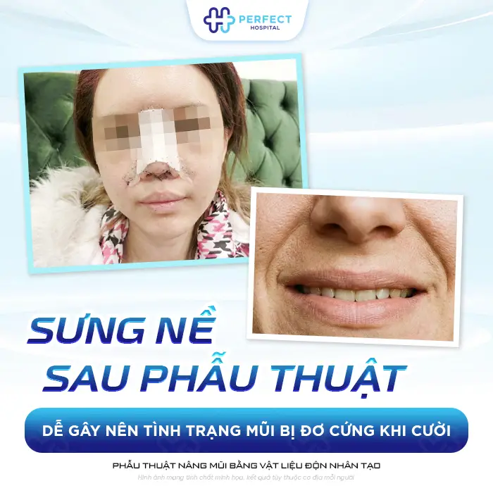 Bác Sĩ Giải Đáp: Nâng Mũi Xong Cười Bị Đơ Và Cách Khắc Phục