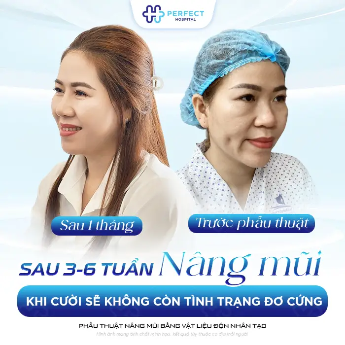 Bác Sĩ Giải Đáp: Nâng Mũi Xong Cười Bị Đơ Và Cách Khắc Phục