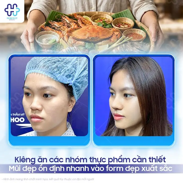 Nâng Mũi Xong Kiêng Ăn Gì Để Nhanh Lành Và Không Bị Sẹo?