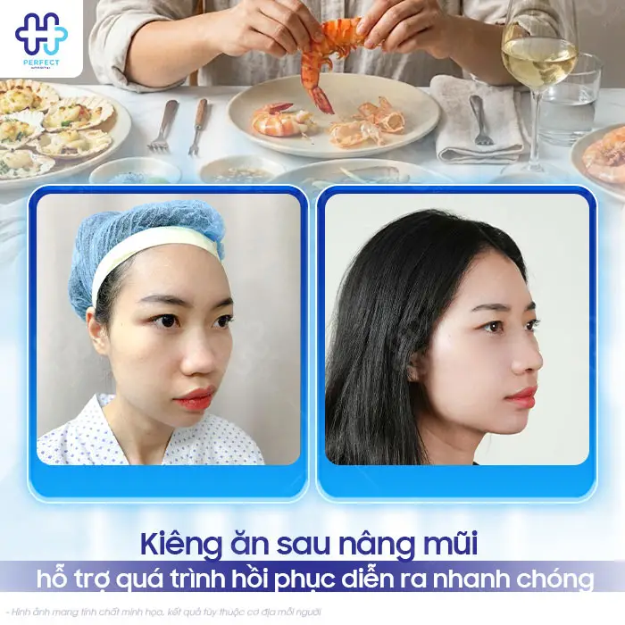 Nâng Mũi Xong Kiêng Ăn Gì Để Nhanh Lành Và Không Bị Sẹo?
