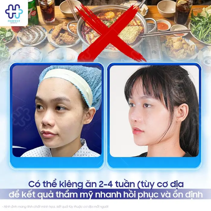 Nâng Mũi Xong Kiêng Ăn Gì Để Nhanh Lành Và Không Bị Sẹo?