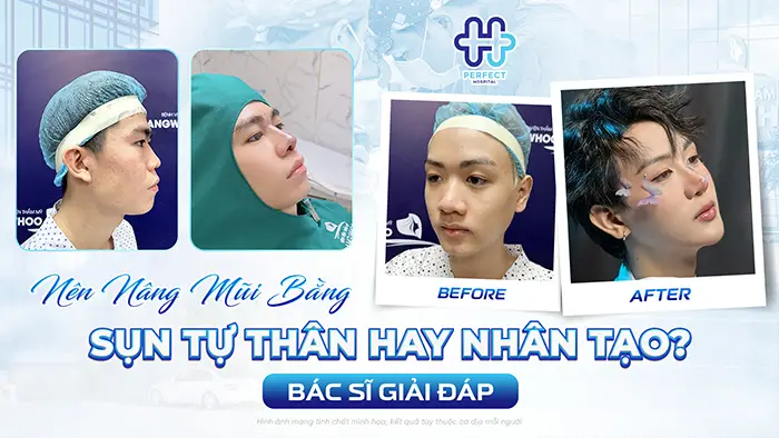 Nên Nâng Mũi Bằng Sụn Tự Thân Hay Nhân Tạo? Bác Sĩ Giải Đáp