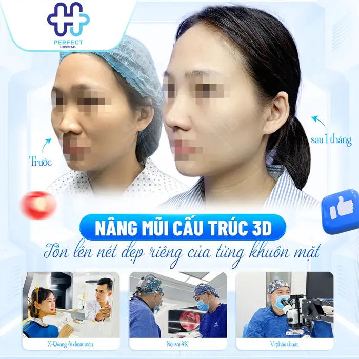 Nên Nâng Mũi Bằng Sụn Tự Thân Hay Nhân Tạo? Bác Sĩ Giải Đáp