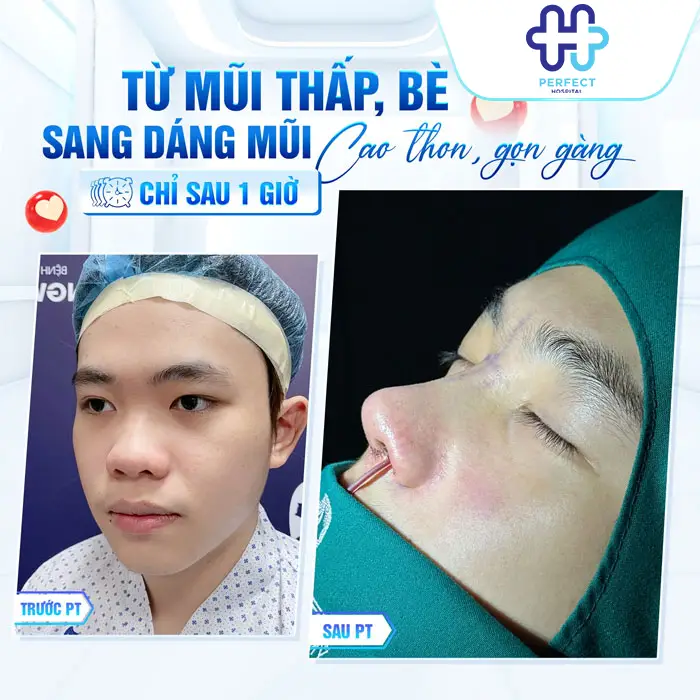 Nên Nâng Mũi Bằng Sụn Tự Thân Hay Nhân Tạo? Bác Sĩ Giải Đáp