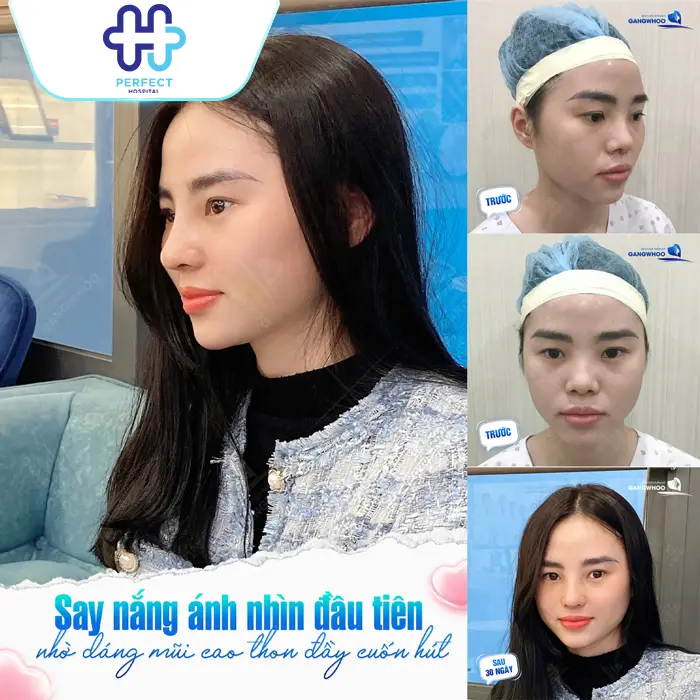 Nên Nâng Mũi Bằng Sụn Tự Thân Hay Nhân Tạo? Bác Sĩ Giải Đáp