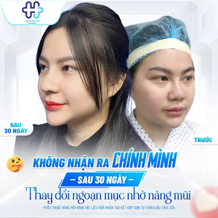 Nên Nâng Mũi S Line Hay L Line? Dáng Mũi Nào Phù Hợp Hơn?