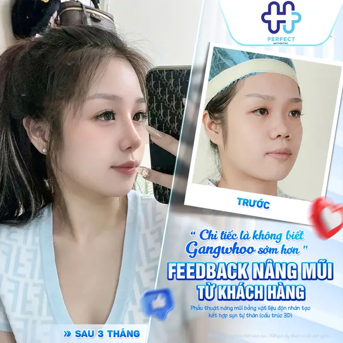 Nên Nâng Mũi S Line Hay L Line? Dáng Mũi Nào Phù Hợp Hơn?