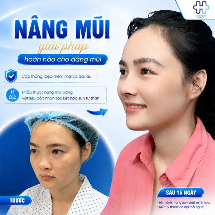 Nên Tiêm Filler Hay Nâng Mũi? So Sánh Chi Tiết Từ Perfect Hospital
