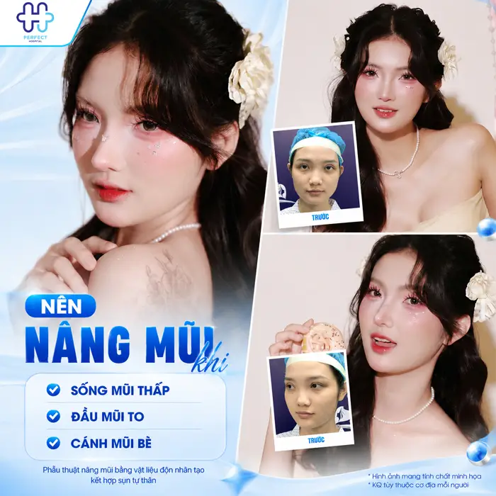 Nên Tiêm Filler Hay Nâng Mũi? So Sánh Chi Tiết Từ Perfect Hospital