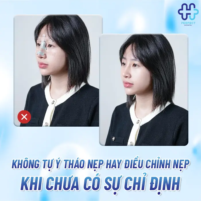 Nẹp Mũi Sau Khi Nâng Có Tác Dụng Gì? Giải Đáp Từ Perfect Hospital