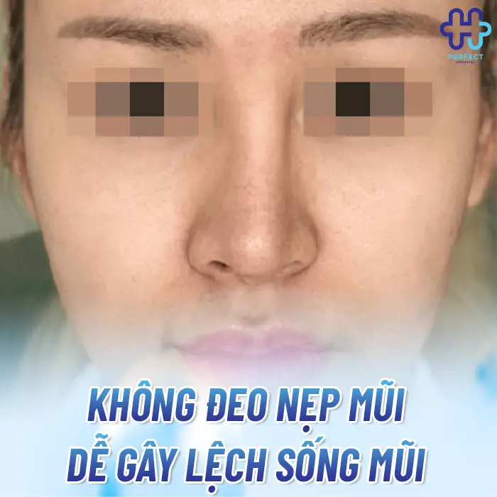 Nẹp Mũi Sau Khi Nâng Có Tác Dụng Gì? Giải Đáp Từ Perfect Hospital