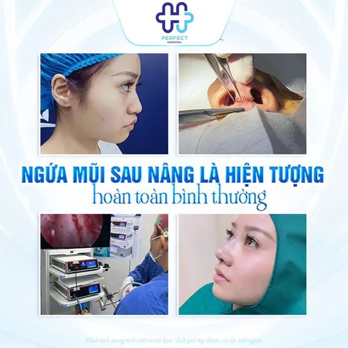 Ngứa Mũi Sau Khi Nâng Có Sao Không? Nguyên Nhân Và Cách Xử Lý