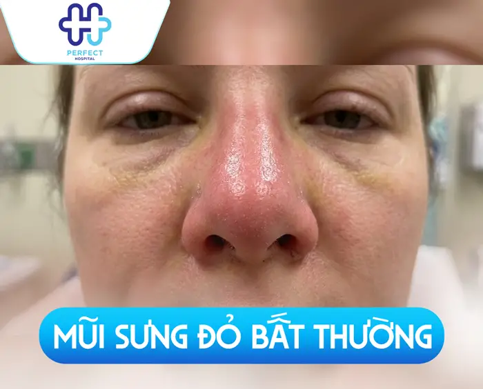 Ngứa Mũi Sau Khi Nâng Có Sao Không? Nguyên Nhân Và Cách Xử Lý