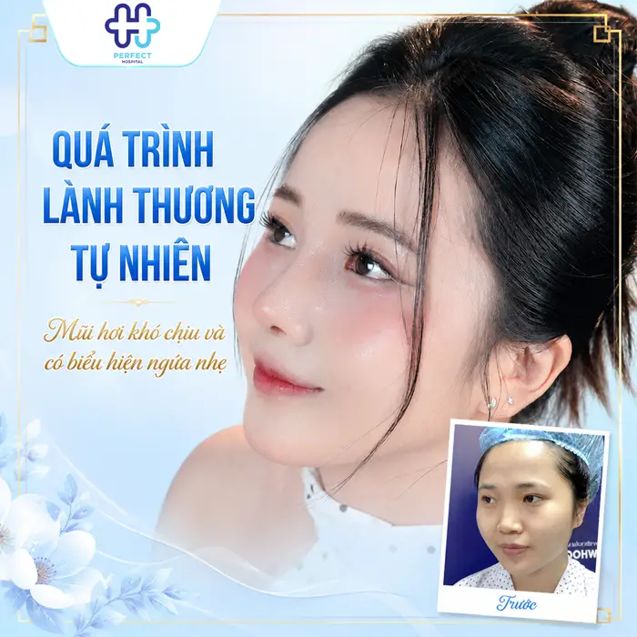 Ngứa Mũi Sau Khi Nâng Có Sao Không? Nguyên Nhân Và Cách Xử Lý