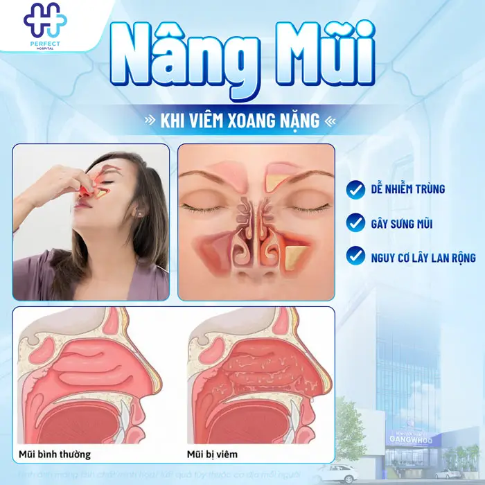 Người Bị Viêm Xoang Có Nâng Mũi Được Không Và Lưu Ý An Toàn