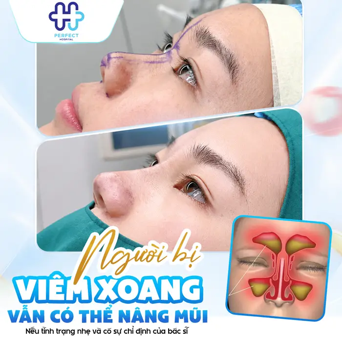 Người Bị Viêm Xoang Có Nâng Mũi Được Không Và Lưu Ý An Toàn