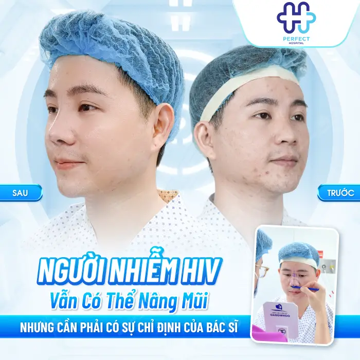 Nhiễm HIV có nâng mũi được không? Giải đáp an toàn từ chuyên gia