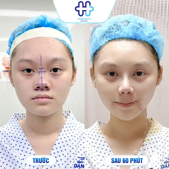 Những Hiện Tượng Sau Khi Nâng Mũi: Dấu Hiệu Bình Thường & Bất Thường