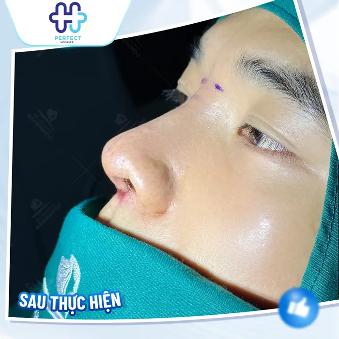 Những Hiện Tượng Sau Khi Nâng Mũi: Dấu Hiệu Bình Thường & Bất Thường