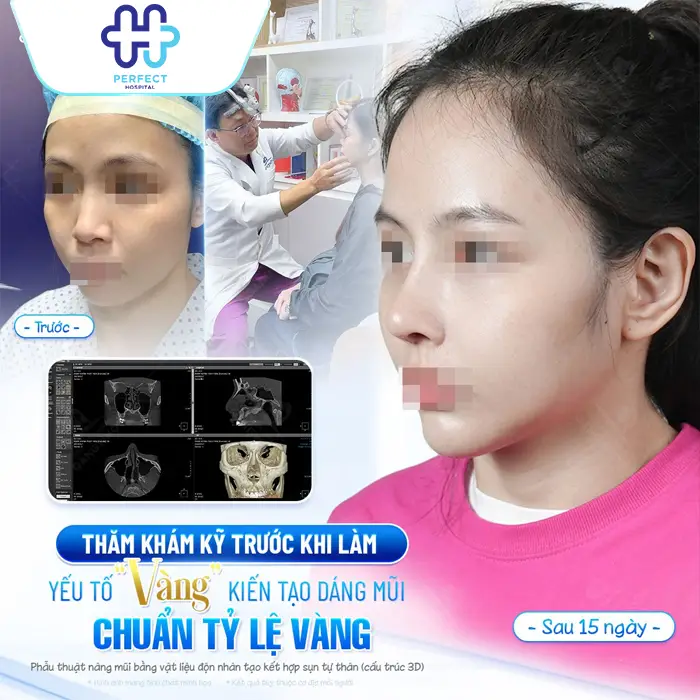 Những Hiện Tượng Sau Khi Nâng Mũi: Dấu Hiệu Bình Thường & Bất Thường