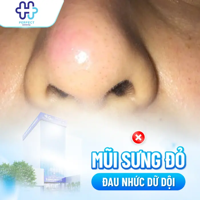 Những Hiện Tượng Sau Khi Nâng Mũi: Dấu Hiệu Bình Thường & Bất Thường