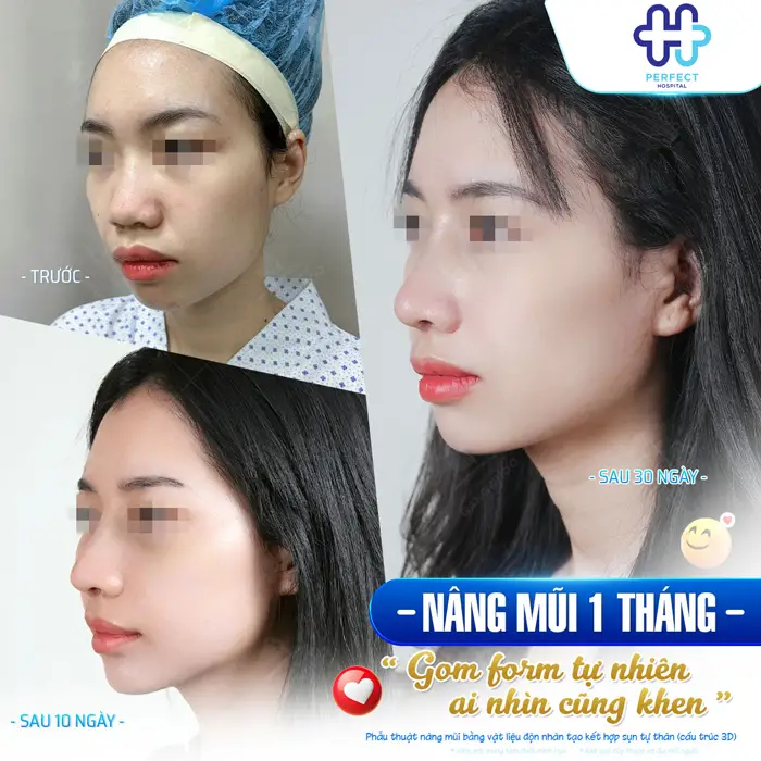 Những Hiện Tượng Sau Khi Nâng Mũi: Dấu Hiệu Bình Thường & Bất Thường