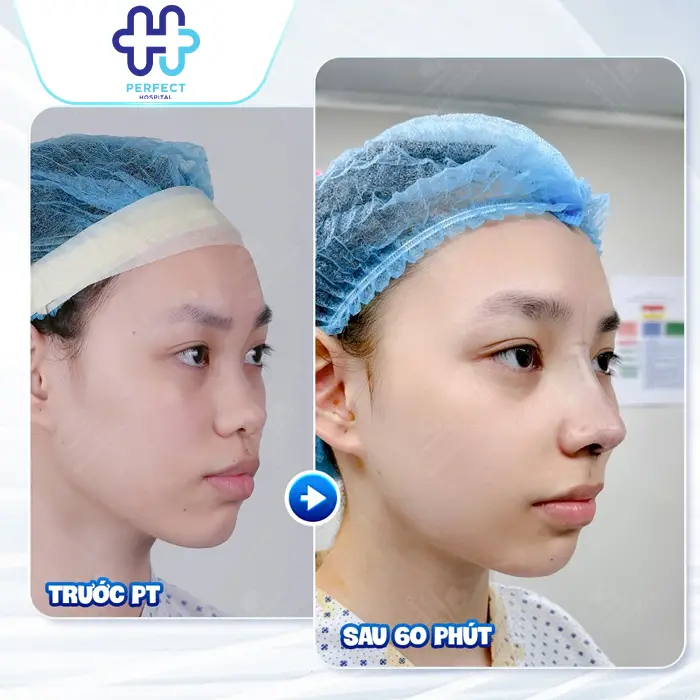 Những Trường Hợp Không Được Nâng Mũi: Những Ai Cần Cân Nhắc Kỹ?
