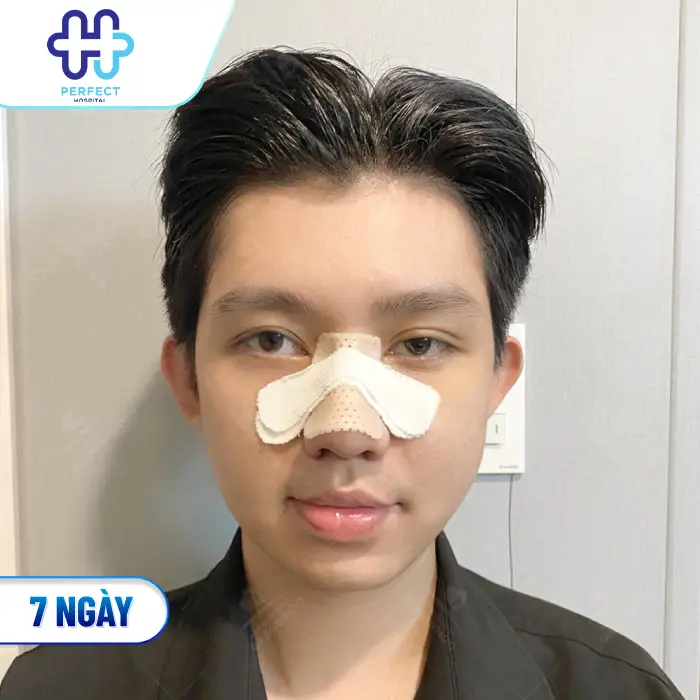 Quá Trình Phục Hồi Sau Nâng Mũi Diễn Ra Như Thế Nào? Cần Lưu Ý Gì?