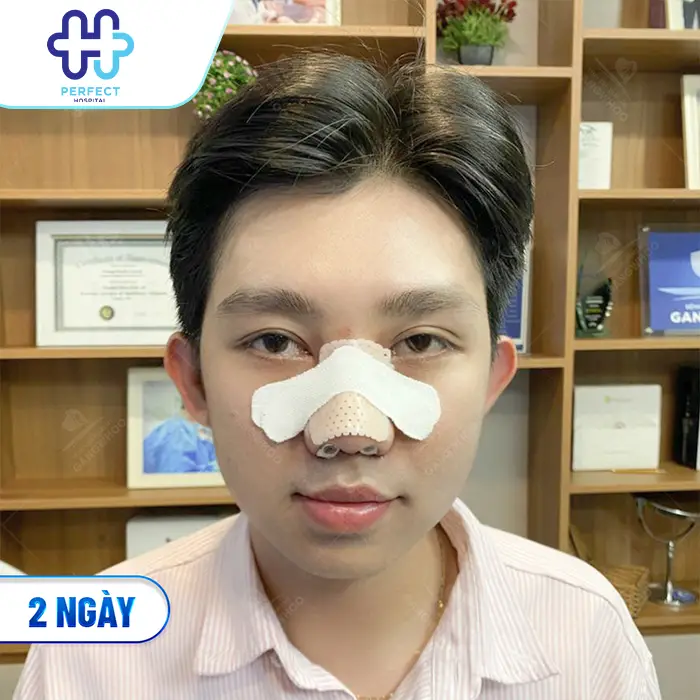 Quá Trình Phục Hồi Sau Nâng Mũi Diễn Ra Như Thế Nào? Cần Lưu Ý Gì?
