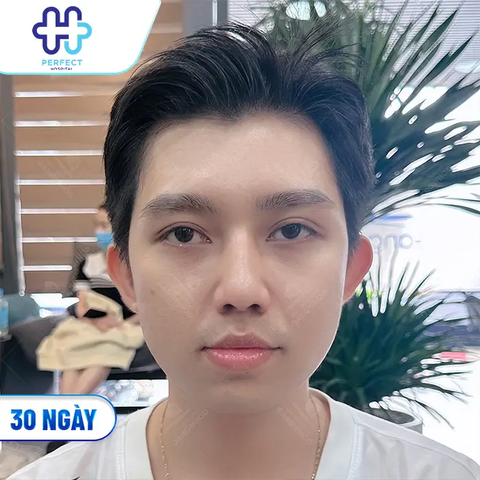 Quá Trình Phục Hồi Sau Nâng Mũi Diễn Ra Như Thế Nào? Cần Lưu Ý Gì?