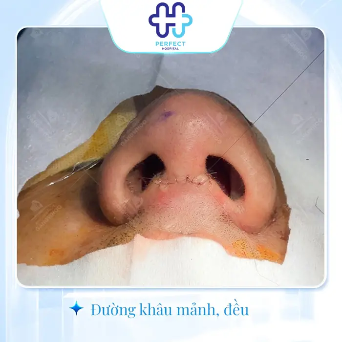 Quy Trình Nâng Mũi Chuẩn Y Khoa Gồm Những Bước Nào?