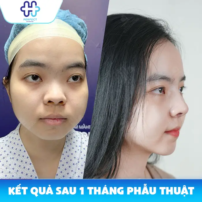 Quy Trình Nâng Mũi Chuẩn Y Khoa Gồm Những Bước Nào?