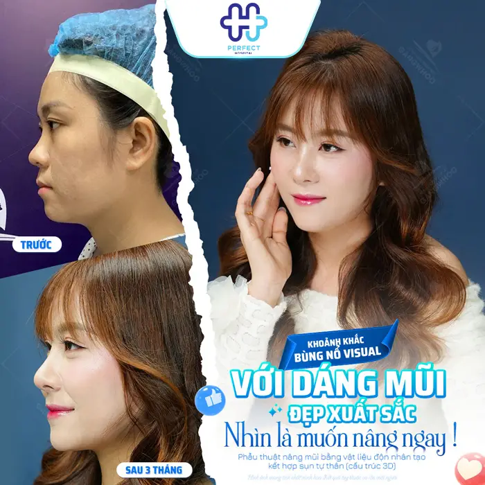 Review Nâng Mũi Tại Perfect Hospital – Ưu Điểm, Chi Phí Hợp Lý