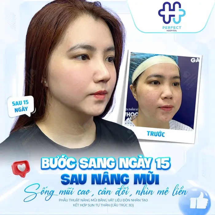 Review Nâng Mũi Tại Perfect Hospital – Ưu Điểm, Chi Phí Hợp Lý