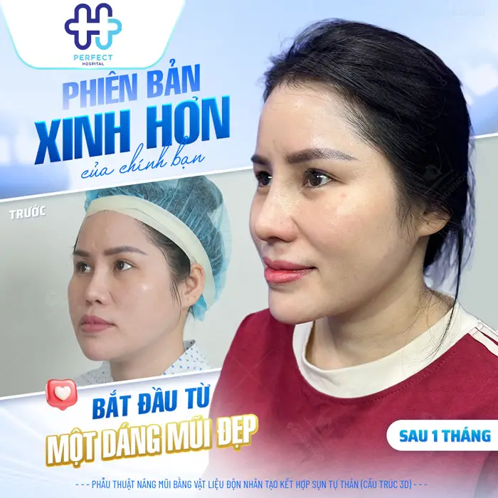 Review Nâng Mũi Tại Perfect Hospital – Ưu Điểm, Chi Phí Hợp Lý