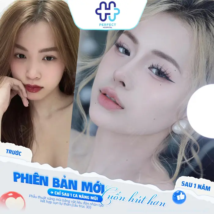 Review Nâng Mũi Tại Perfect Hospital – Ưu Điểm, Chi Phí Hợp Lý