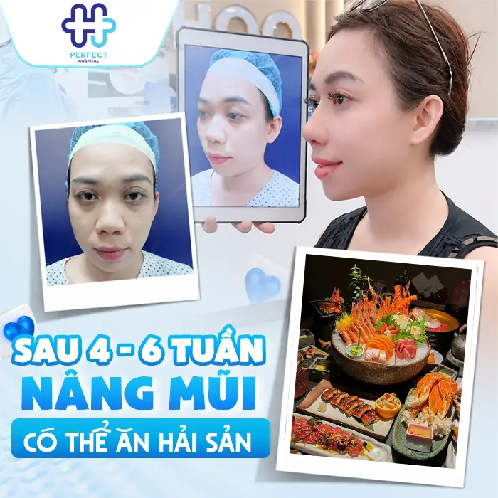 Sau Nâng Mũi Kiêng Ăn Hải Sản Bao Lâu Và Khi Nào Ăn Lại An Toàn